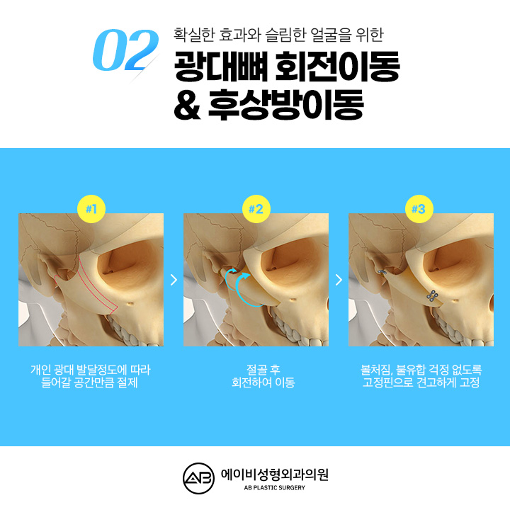 Can We Compare Before and After Cheekbone Surgery? image 4