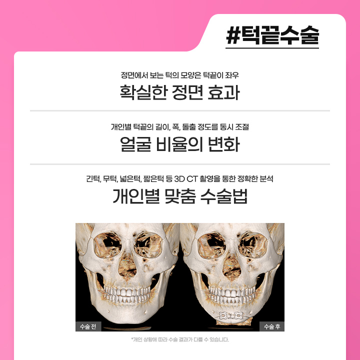안면윤곽수술후붓기 때문에 걱정된다면 관련 이미지 3