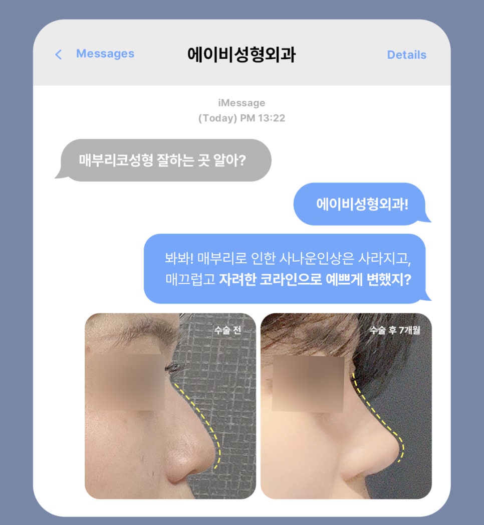 매부리코성형 자연스럽게 교정 원한다면 AB성형외과 관련 이미지 2