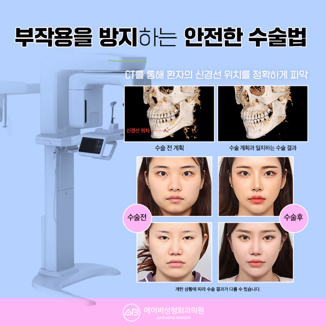 안면윤곽가격 아직도 고민된다면? 관련 이미지 3