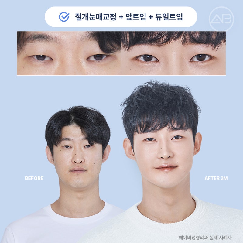 인상을 바꾸는 첫 시작, 에이비성형외과 남자눈성형 관련 이미지 21