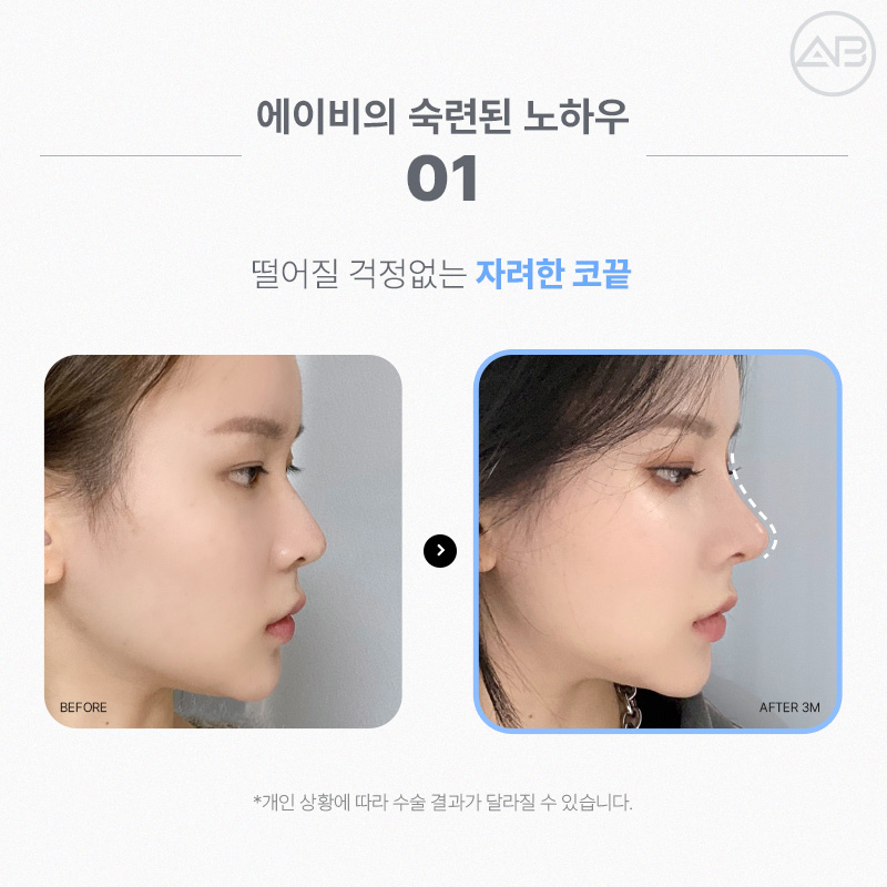 에이비성형외과에서 만나는 자려한 비주라인 코성형 관련 이미지 5