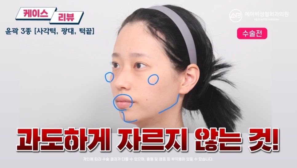 #에이비성형외과#에이비tv#케이스리뷰#윤곽3종수술 관련 이미지 3