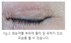 [칼럼] 눈 재수술이 더 어려운 이유는 무엇일까요? 관련 이미지 2