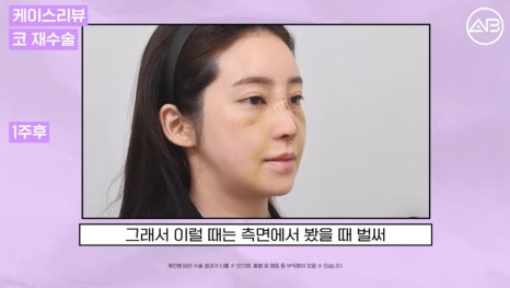 #AB Plastic Surgery #AB TV #Case Review #Nose Surgery #Revision Rhinoplasty image 5