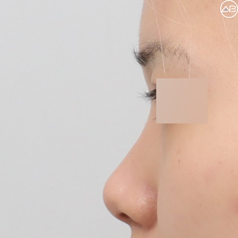 AB Plastic Surgery Natural Glamorous Rhinoplasty Case Review (Feat. Dr. Jo Gyu-sang) image 2