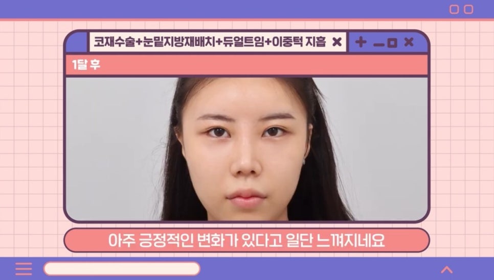 #AB Plastic Surgery #AB TV ##Case Review #Eye Surgery #Nose Revision Surgery image 4