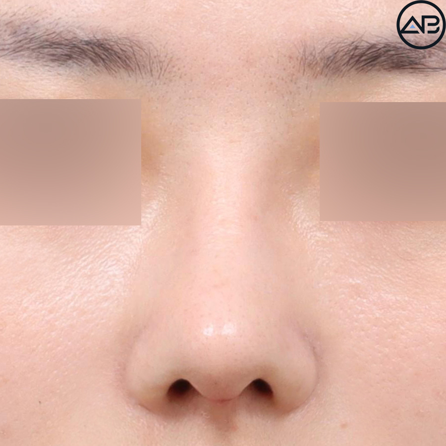 에이비성형외과 자려한코성형 케이스리뷰 관련 이미지 4