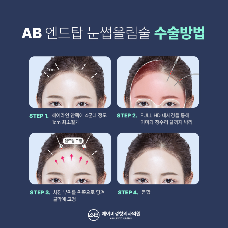 What Is the Endtop Eyebrow Lift That So Many People in Their 20s and 30s Are Getting? image 2