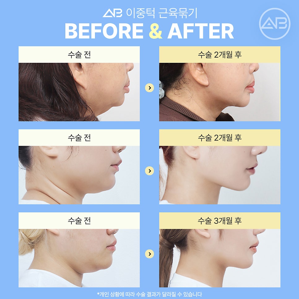 The Secret to a Slim Jawline, AB Plastic Surgery Double Chin Muscle Binding image 9