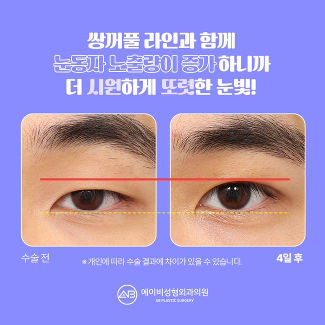 에이비성형외과 썸남눈성형 이게 뭔데? 관련 이미지 7
