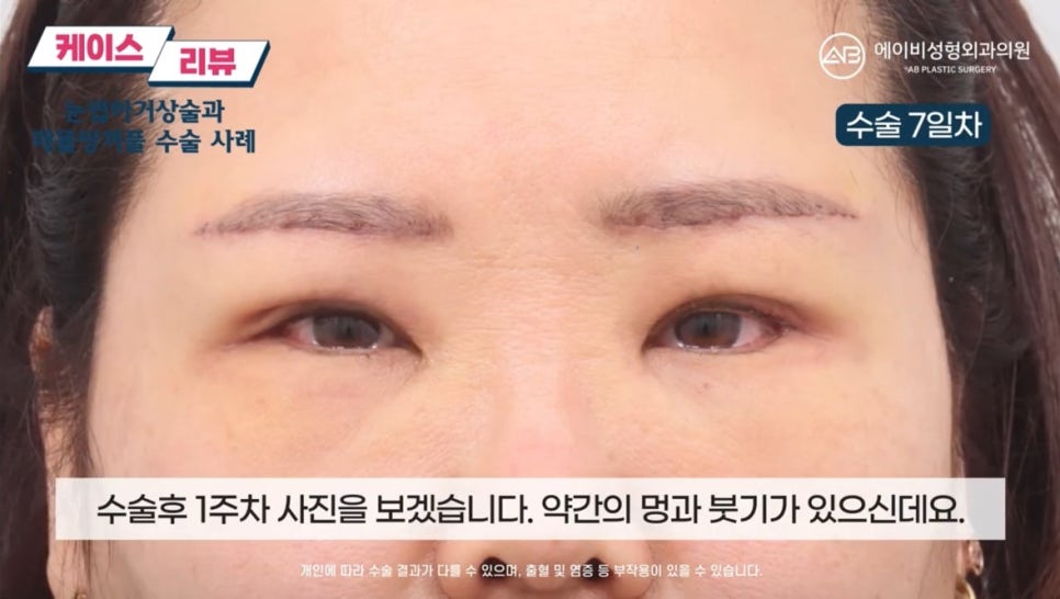 #에이비성형외과#에이비tv#케이스리뷰#중년눈성형 관련 이미지 7