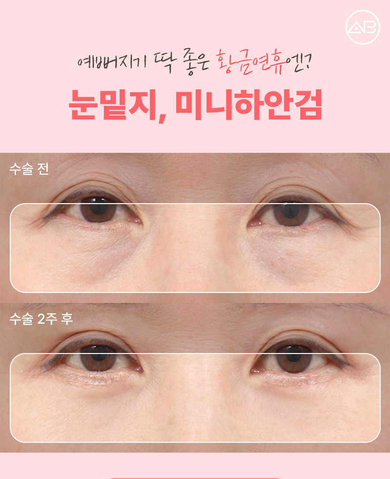 에이비성형외과 5월 황금연휴 이벤트 소식 관련 이미지 2