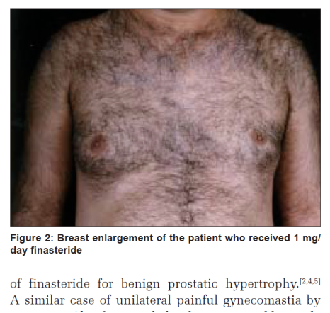 [Gynecomastia Column] Can Gynecomastia Develop After Taking Hair Loss Medication? image 2