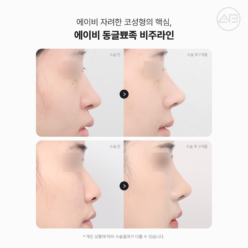 자려한비주라인코성형 AB성형외과에서 완성해보세요 관련 이미지 6