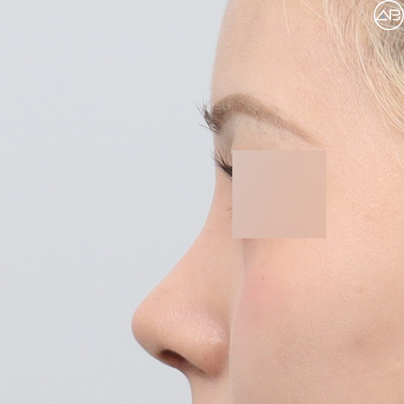 AB Plastic Surgery Natural Glamorous Rhinoplasty Case Review (Feat. Dr. Jo Gyu-sang) image 5