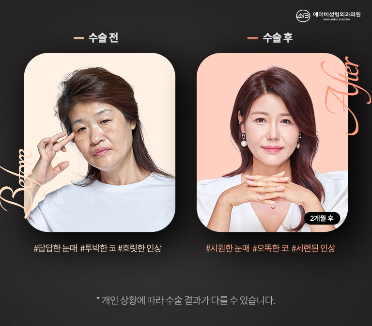 [에이비성형외과 방송출연] 엄마는예뻤다 7회 안성엄마병원 담당주치의 관련 이미지 7