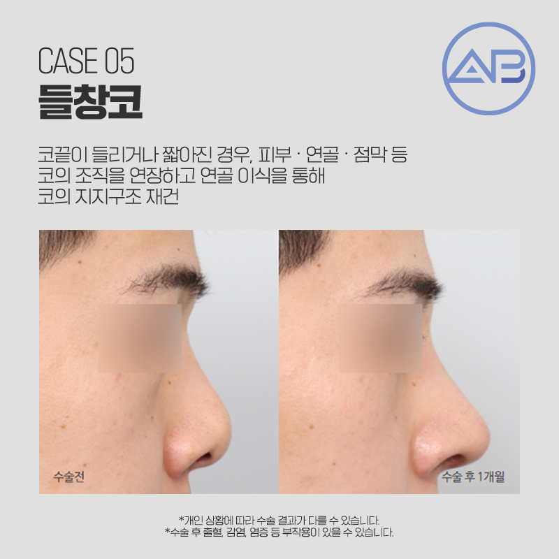 코재수술성형외과 에이비만 믿어! 관련 이미지 5