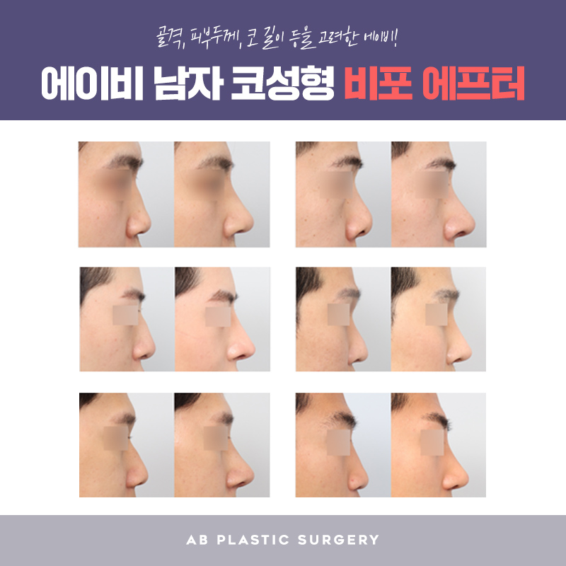 남자코수술전후 차이 이렇게나 관련 이미지 3