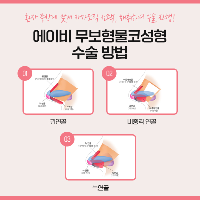무보형물코성형 이렇게나 달라 관련 이미지 4