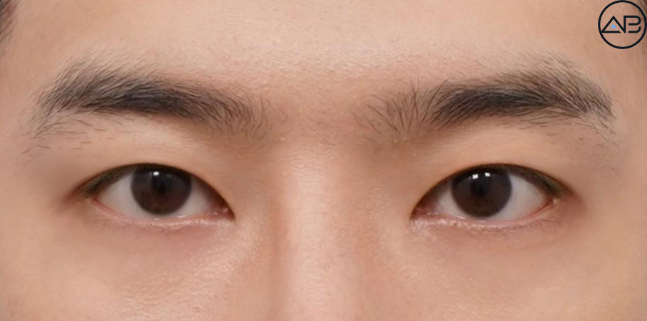AB Plastic Surgery Men’s Eye Surgery - First Snow Case Review image 3