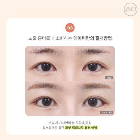 AB Plastic Surgery Eye Corner Surgery: Types and Reviews of Epicanthoplasty, Canthoplasty, and Lower Canthoplasty image 9