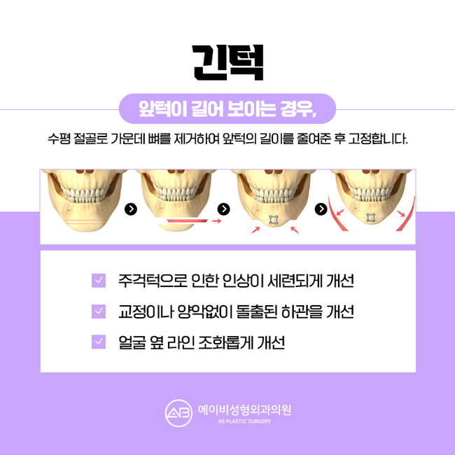 Why You Should Thoroughly Research Chin Surgery Before Having It image 5