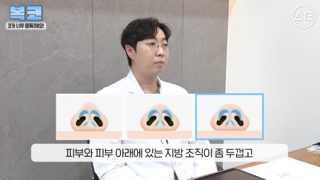 #에이비성형외과#에이비tv#코성형#복코성형 관련 이미지 8