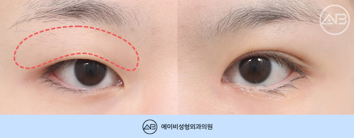 에이비성형외과 무쌍 여자 눈매교정 쌍꺼풀 수술 체크포인트 관련 이미지 3