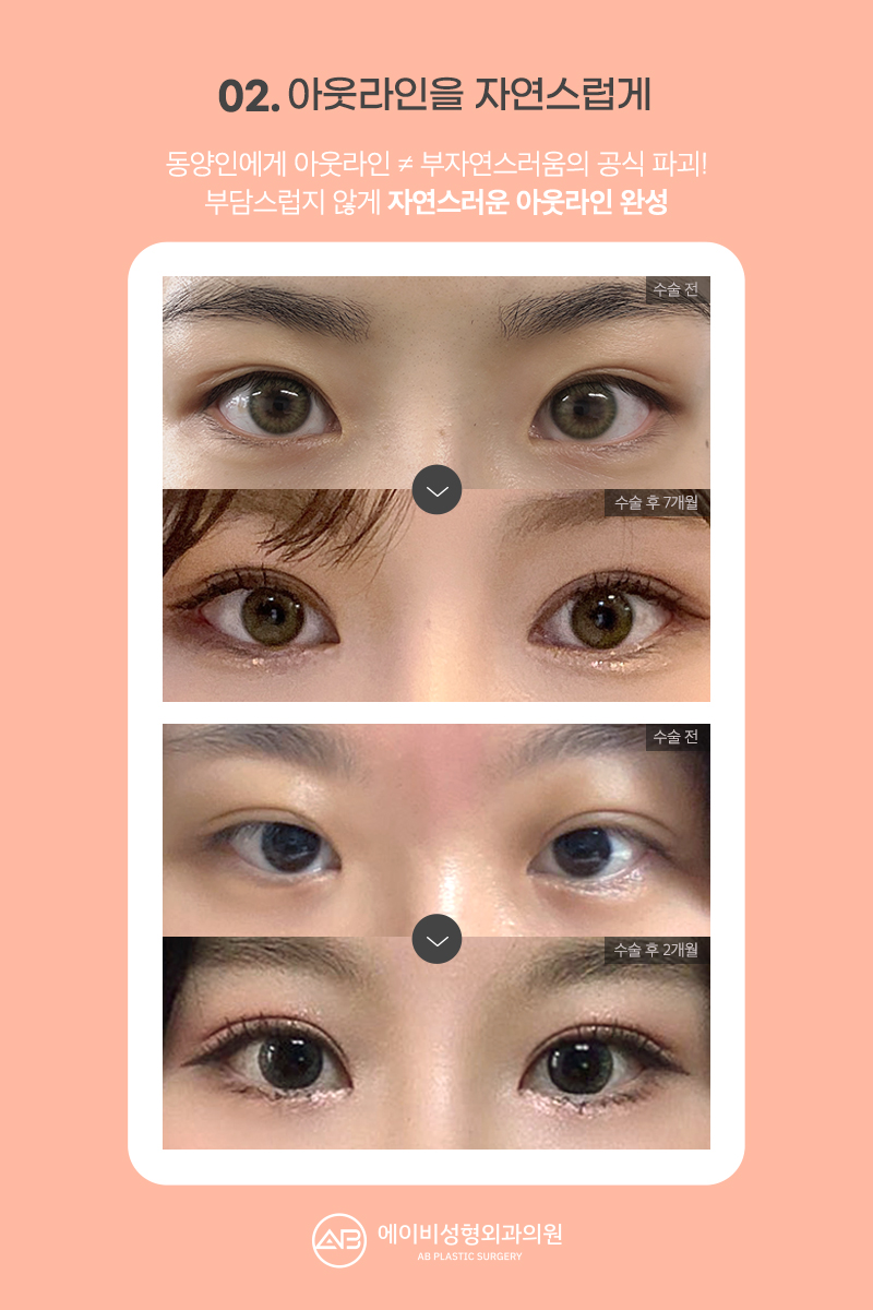 요즘 대세 세미아웃 눈성형 성공하려면? 관련 이미지 6