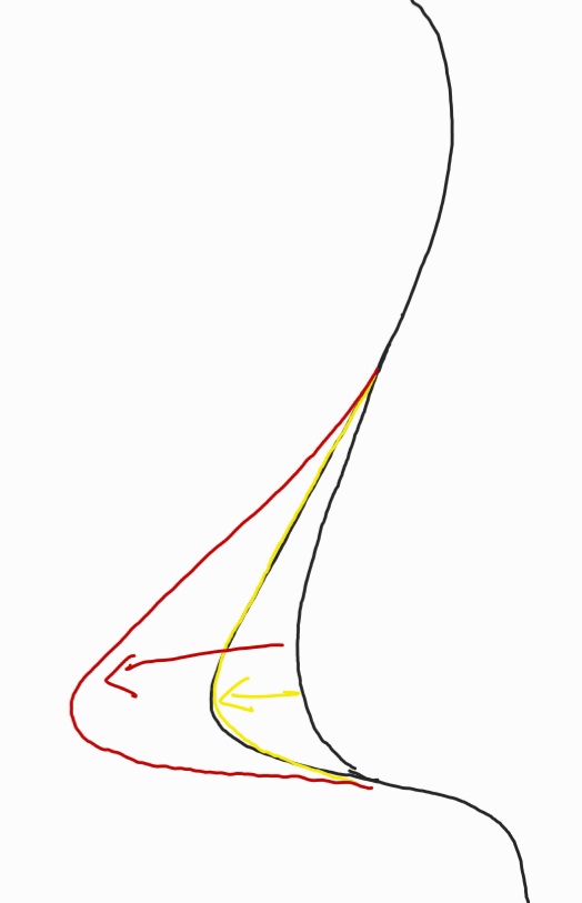 Q. I don’t have much of a nasal bridge, but I want to have only the tip of my nose operated on without an implant. Is that possible? If I have surgery without an implant, how is it performed? image 3