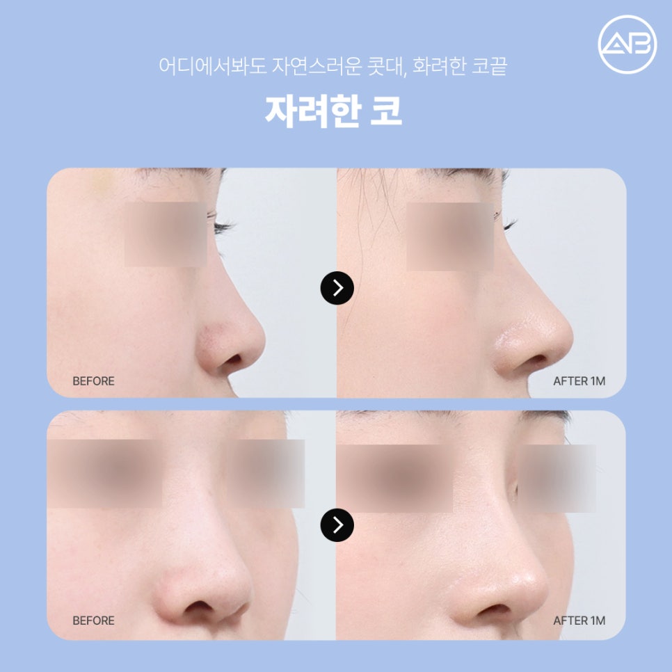 What Are the Special Points of AB Plastic Surgery’s Stylish Nose Surgery? image 6