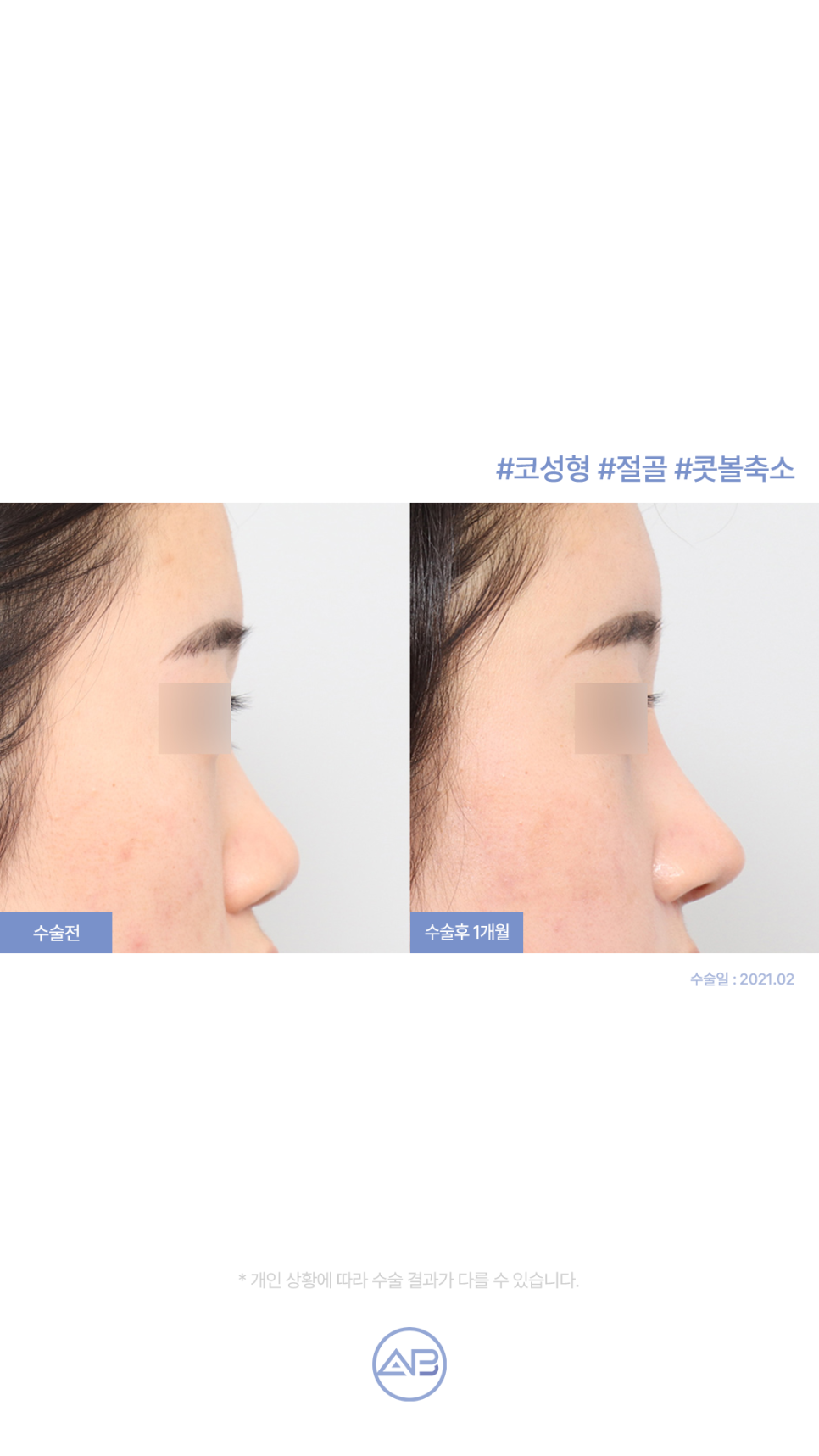 에이비성형외과 자려한코성형 수술전후 관련 이미지 4
