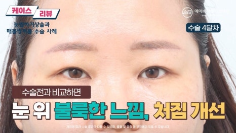 #에이비성형외과#에이비tv#케이스리뷰#중년눈성형 관련 이미지 8