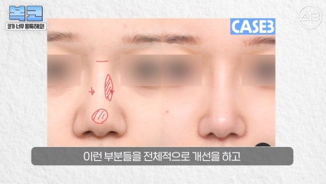 #에이비성형외과#에이비tv#코성형#복코성형 관련 이미지 22