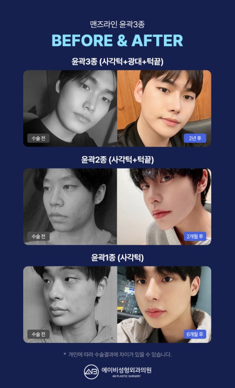 남자 윤곽수술잘하는곳 볼 때 고려해야 할 점 관련 이미지 4