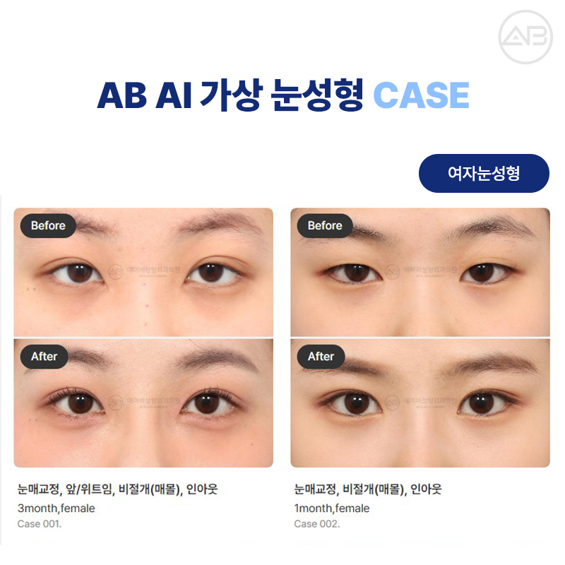 에이비성형외과 AI 가상 눈성형 원하는 결과를 미리 볼 수 있다! 관련 이미지 3