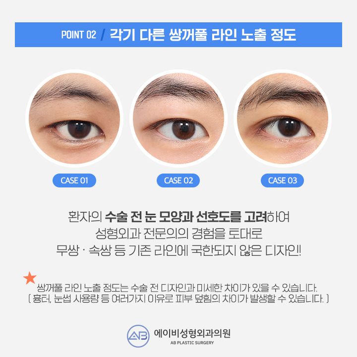 남자눈성형잘하는곳 에이비 라며? 관련 이미지 3