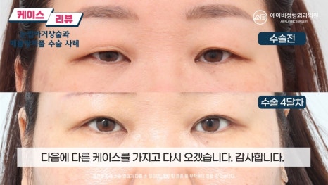 #에이비성형외과#에이비tv#케이스리뷰#중년눈성형 관련 이미지 9