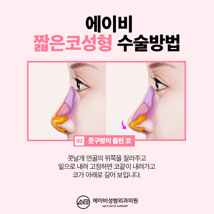 If You’re Looking Into Short Nose Surgery, Pay Attention to This Place image 4