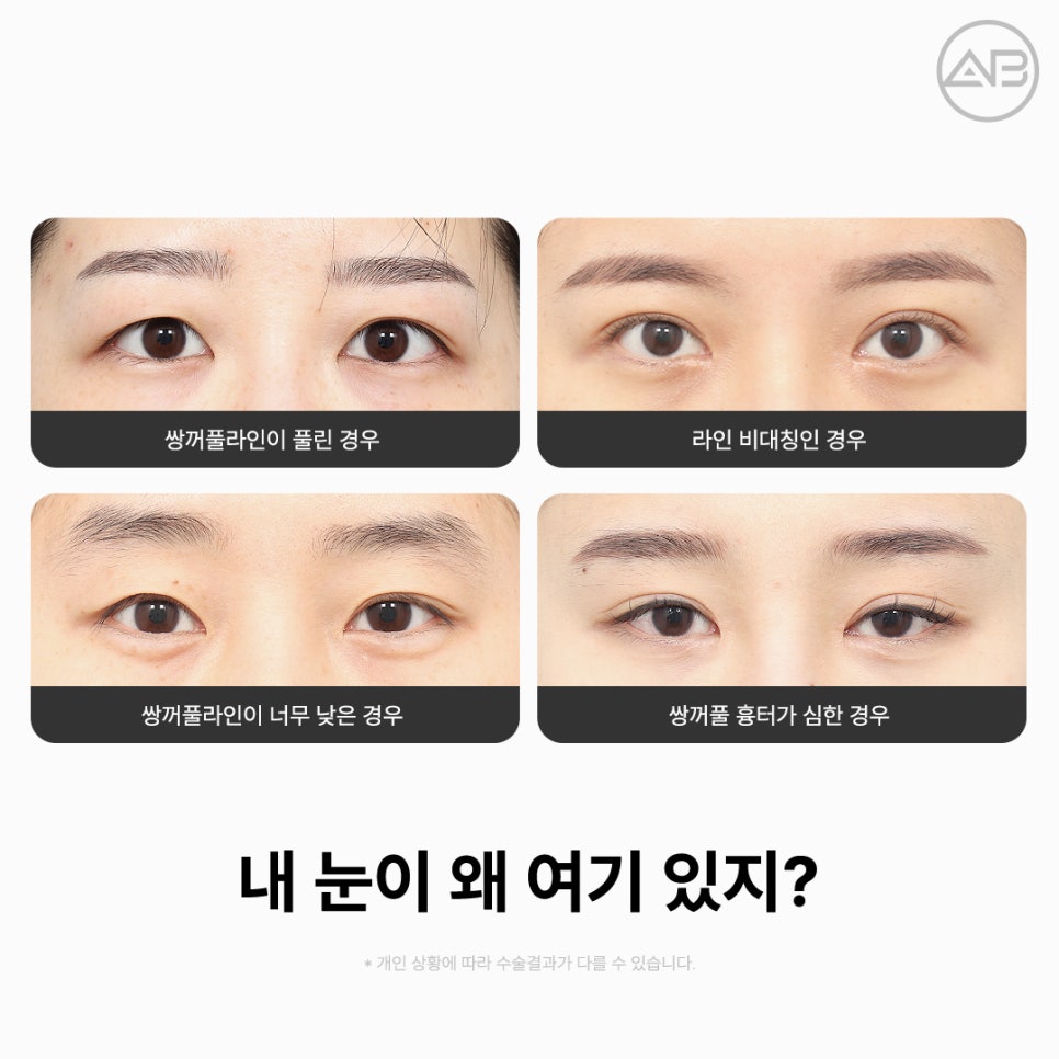 에이비성형외과 쌍꺼풀 짝눈 눈재수술종류 전후 관련 이미지 3