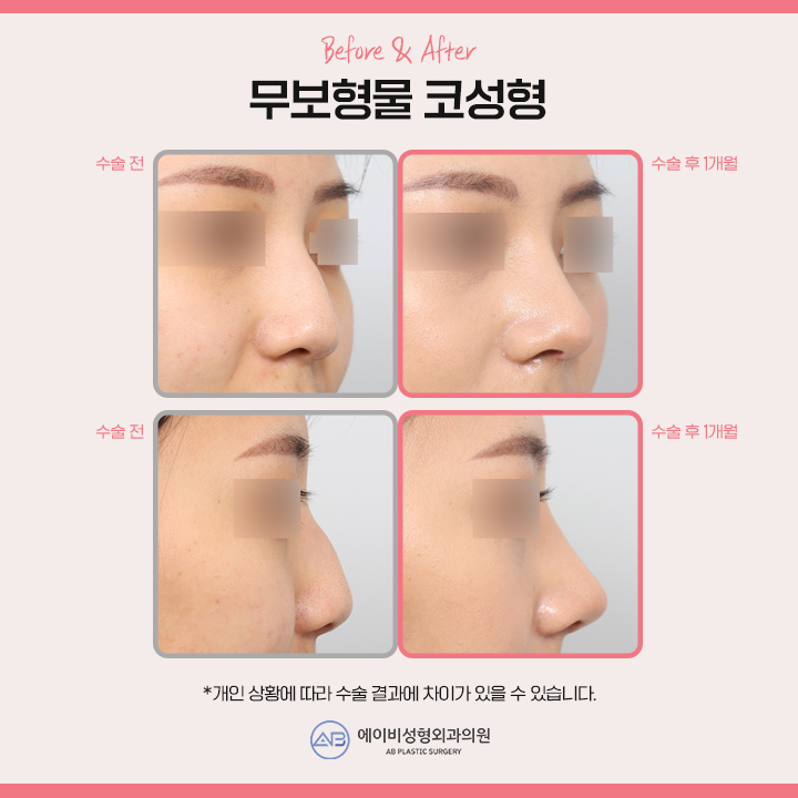 코끝수술후기 만족도가 높은곳 관련 이미지 4