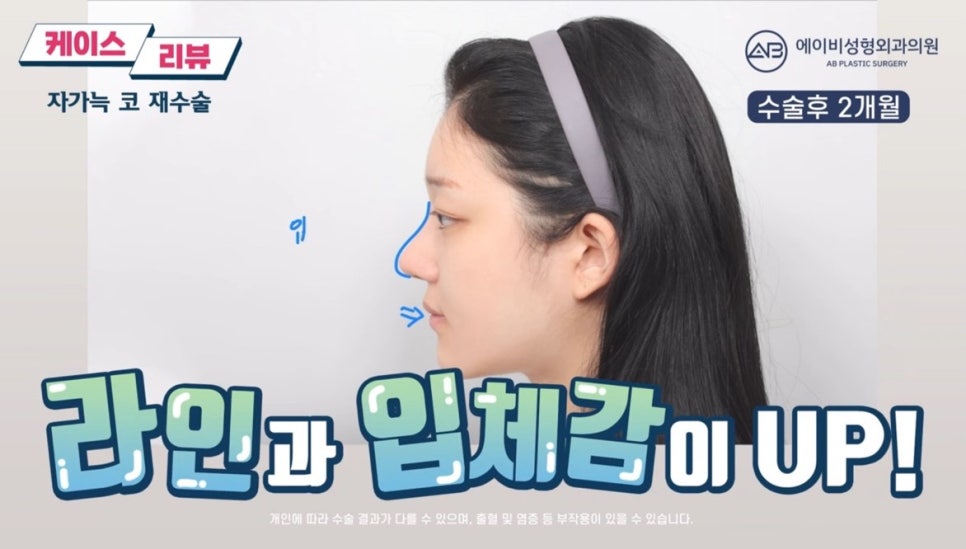 #에이비성형외과#에이비tv#케이스리뷰#코성형#코재수술 관련 이미지 5