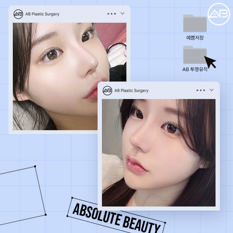 처음부터 예뻤던 것처럼, 에이비성형외과 자려한투명유착 관련 이미지 11