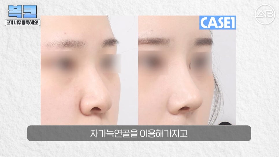 #에이비성형외과#에이비tv#코성형#복코성형 관련 이미지 14