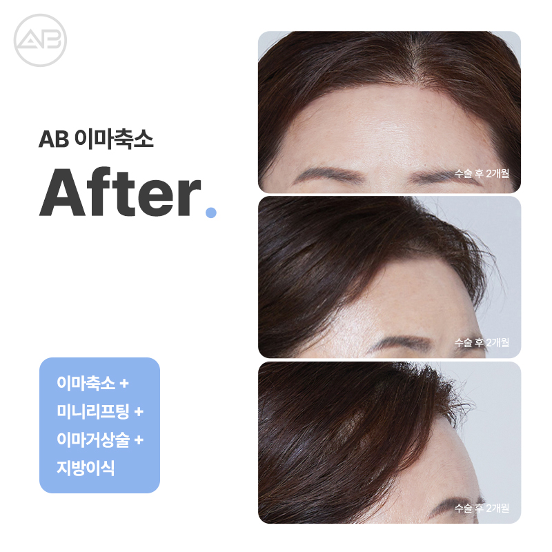 PRS KOREA 2024 : 에이비성형외과의 발표 내용과 성과 관련 이미지 10