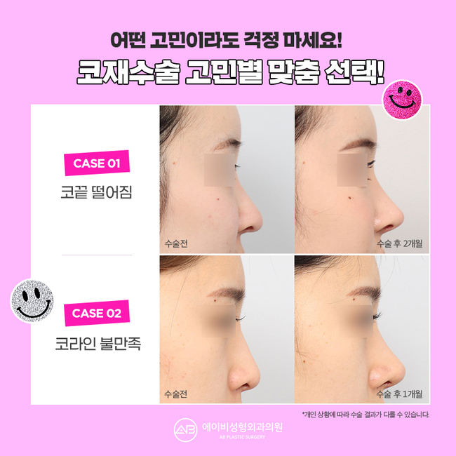 Reasonable Rhinoplasty Revision Costs at AB Plastic Surgery image 4