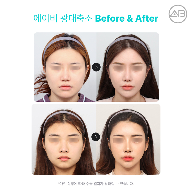 에이비성형외과 광대축소 부드럽고 갸름하게 관련 이미지 5