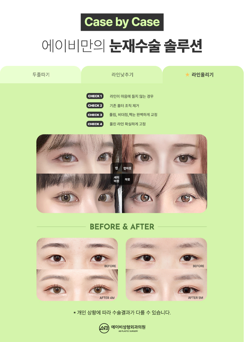 AB Revision Double Eyelid Surgery: What Is Double Folding? image 5