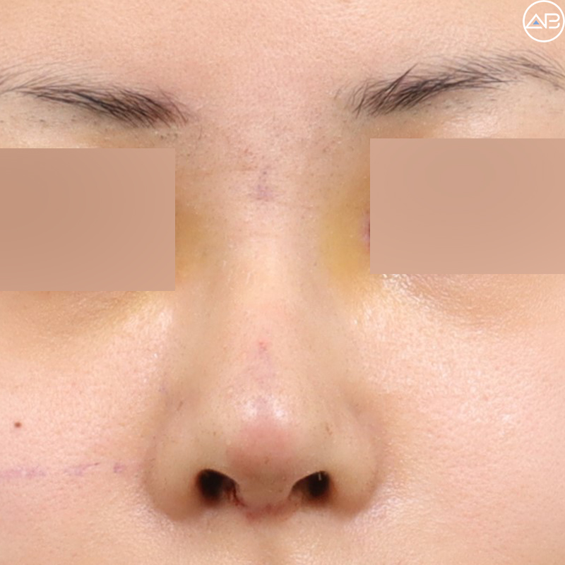 AB Plastic Surgery Natural Glamorous Rhinoplasty Case Review (Feat. Dr. Jo Gyu-sang) image 3